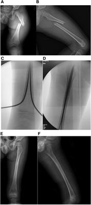 Closed reduction and intramedullary nails for acute completely displaced femoral diaphysis fracture in children aged 2–6